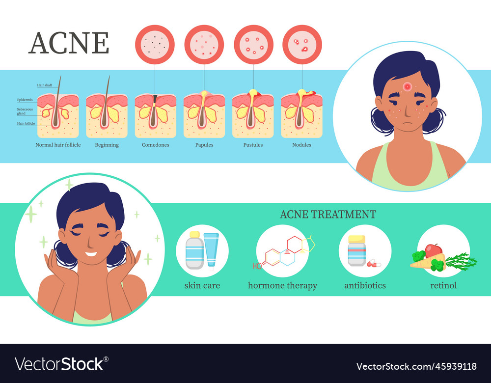 Acne flat face skin treatment infographic Vector Image