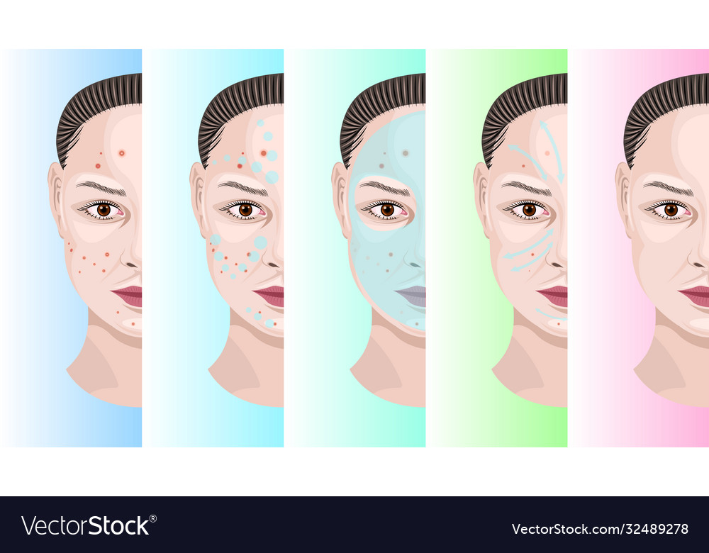 Woman face step treatment acne Royalty Free Vector Image