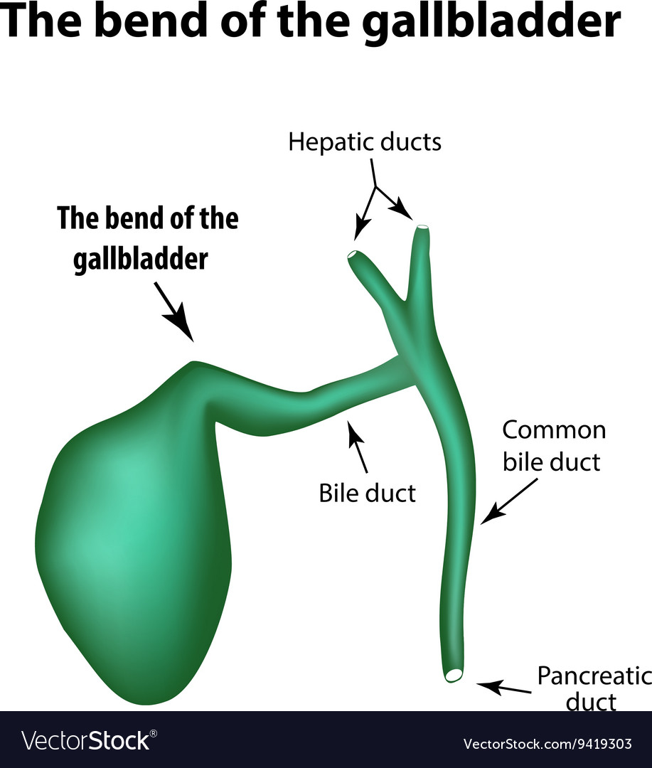 Bend of the gallbladder pathology Royalty Free Vector Image