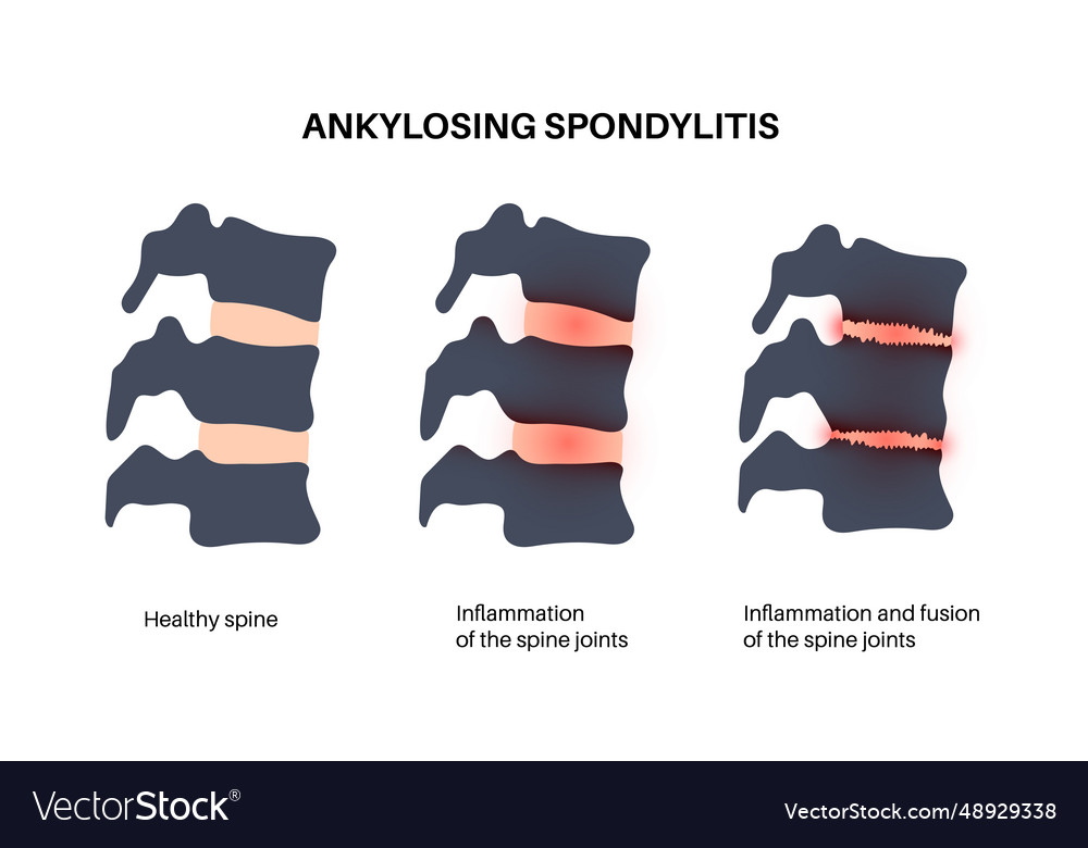 Ankylosing spondylitis disease