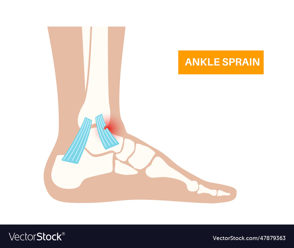 Sprained ankle injury Royalty Free Vector Image