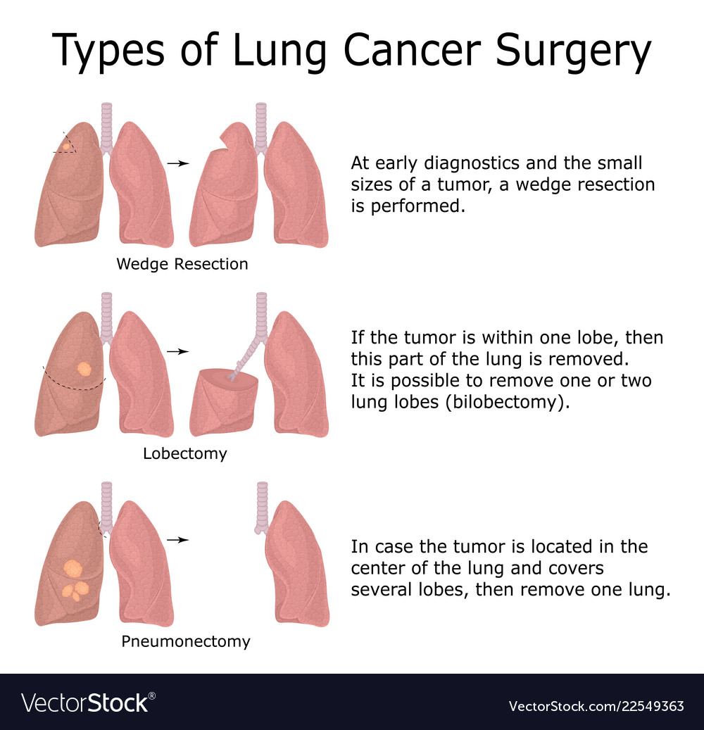 types-of-lung-cancer-surgery-royalty-free-vector-image