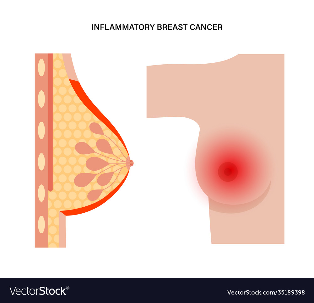 Inflammatorisches Brustkrebskonzept