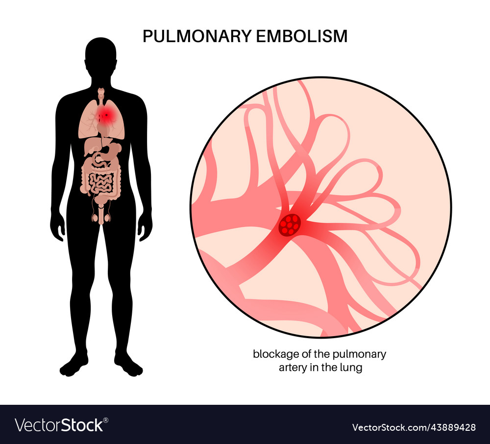 Pulmonary embolism disease Royalty Free Vector Image