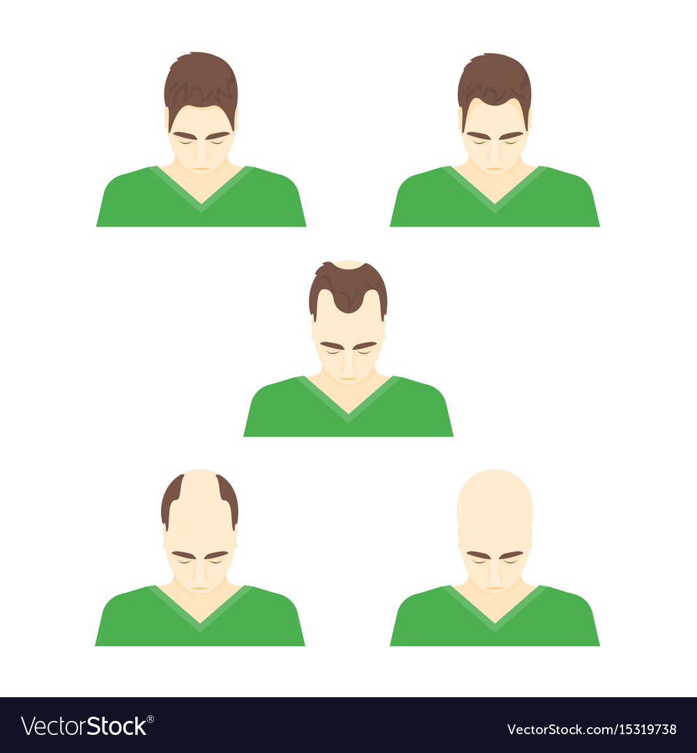 Cartoon stages hair loss in men Royalty Free Vector Image