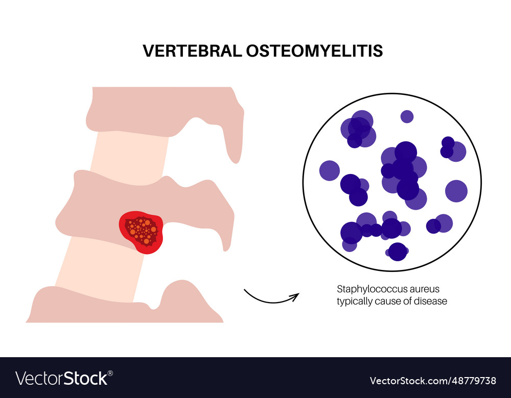 Vertebral Osteomyelitis poster