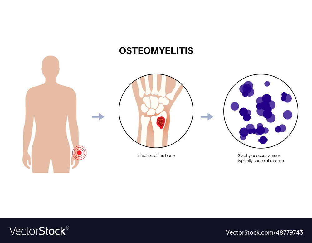 Osteomyelitis des Arms