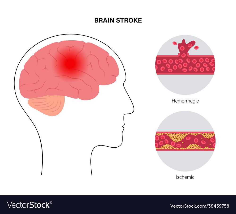 Brain stroke ishemic and hemorrhagic Royalty Free Vector