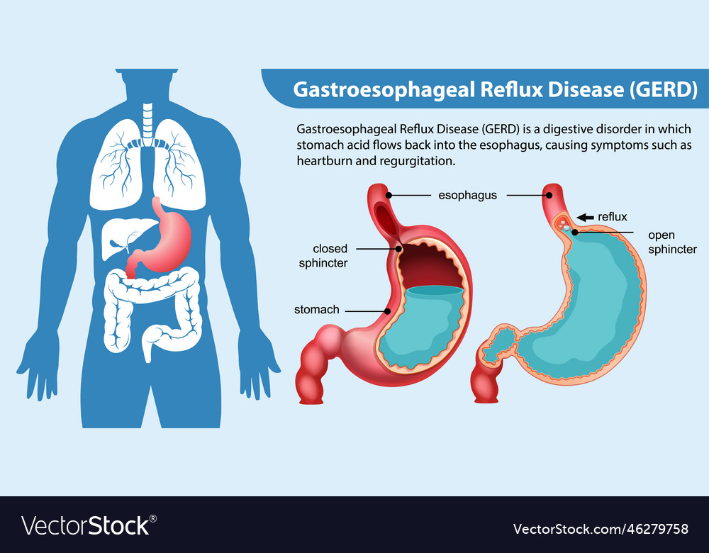 Gastroesophageal reflux disease gerd diagram