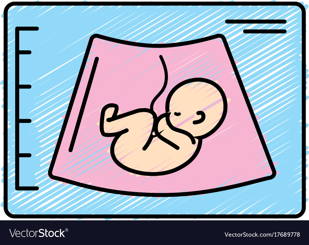 Ultrasound of baby with umbilical cord