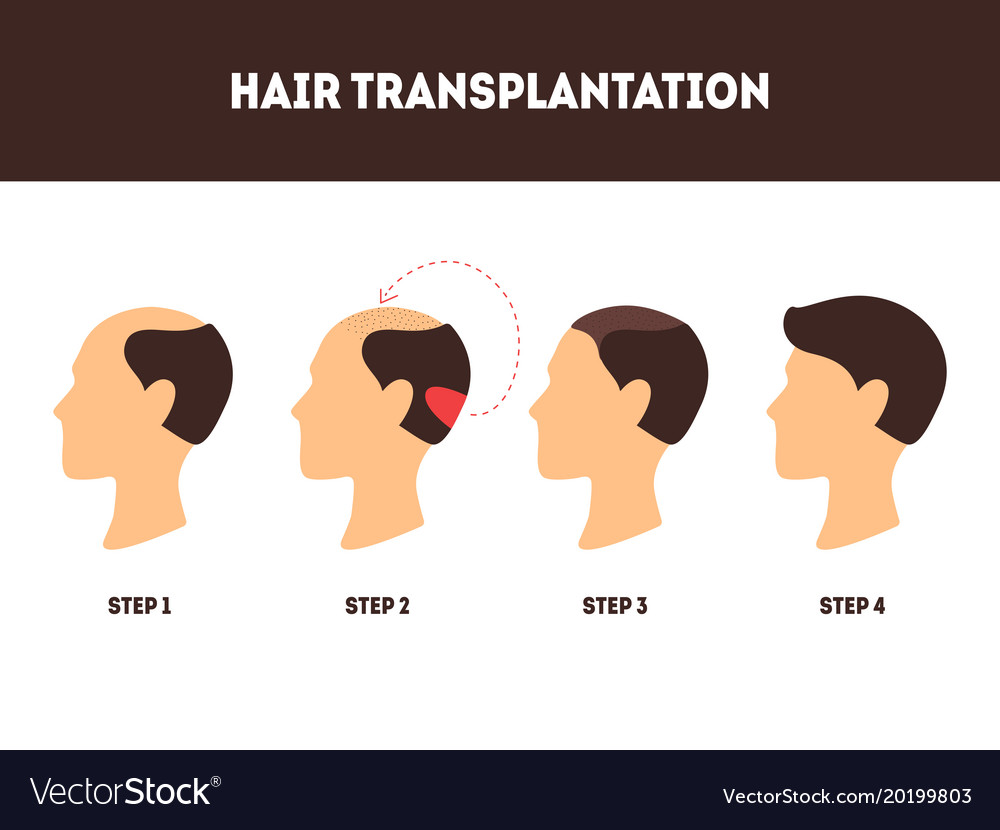 Smart Look Clinic  Hair Transplant is one of the best solution for  Baldness Get it done from a specialist Contact Us for more information or  to schedule an appointment 9137617548 