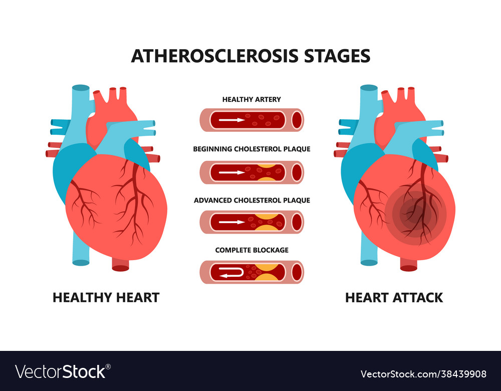 Heart attack and atherosclerosis stages healthy Vector Image