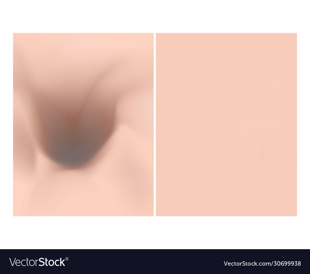 Texture with acne scars and before after
