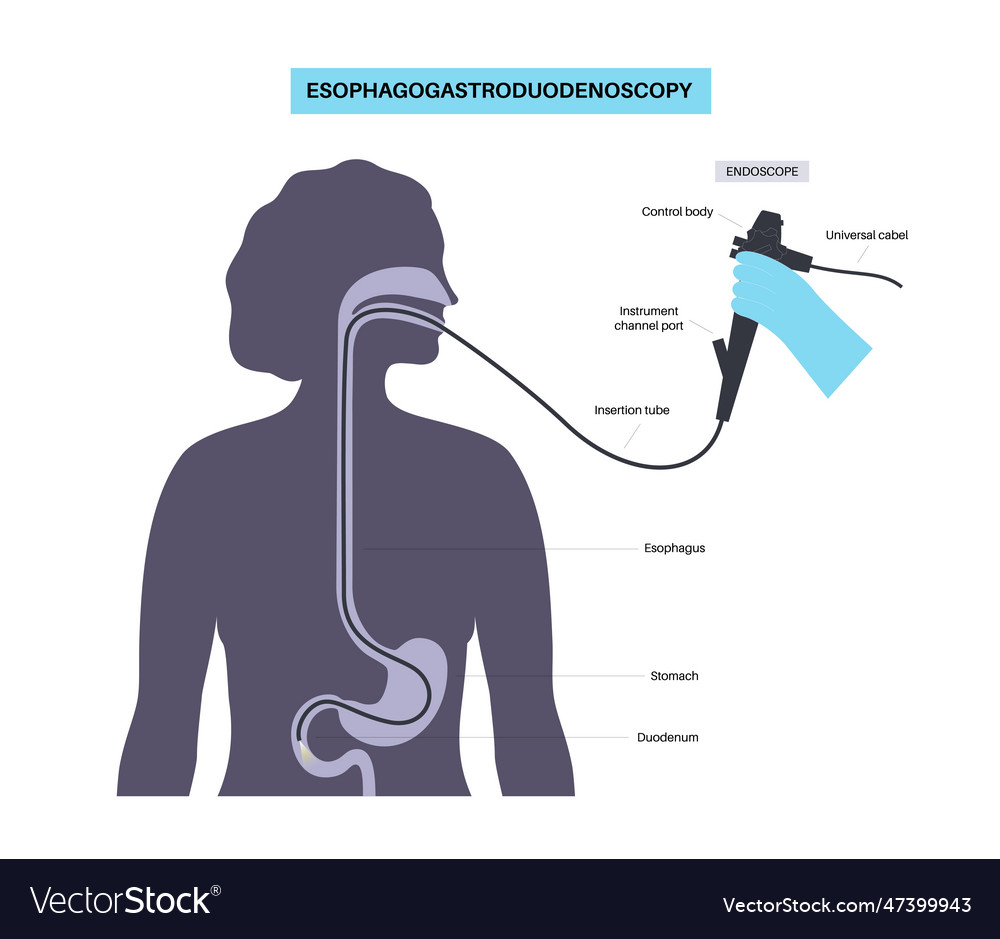 Gastroscopy endoscopy procedure Royalty Free Vector Image
