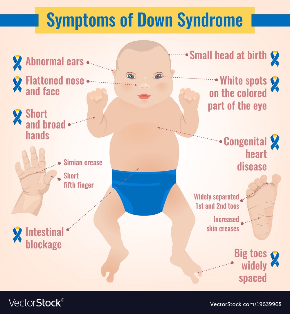 Down Syndrome: Causes, Types, and Symptoms