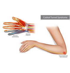 Medical of the cubital and carpal Royalty Free Vector Image