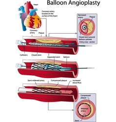 Atherosclerotic plaque Royalty Free Vector Image