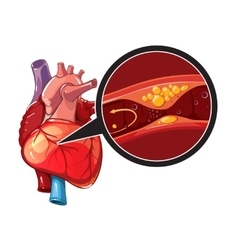 Heart Myocardial infarction Royalty Free Vector Image