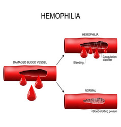 Hemophilia infographics image Royalty Free Vector Image