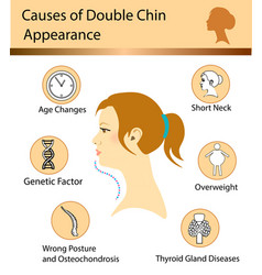 Causes of double chin Royalty Free Vector Image