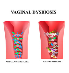 Vaginal Dysbiosis Dysbacteriosis Vagina Vaginitis Vector Vaginal Dysbiosis Dysbacteriosis Vagina Vaginitis Vector