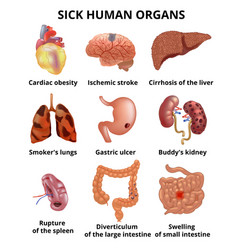 Realistic sick human organs set anatomy Royalty Free Vector