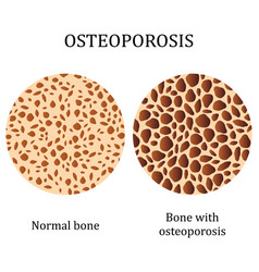 Healthy bone and broken bone with osteoporosis Vector Image