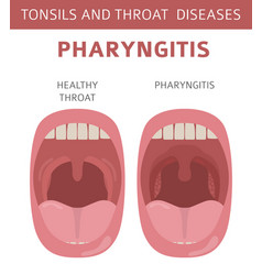 Tonsils and throat diseases tonsillitis symptoms Vector Image