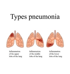 Pneumonia The Anatomical Structure Of The Human Vector Image