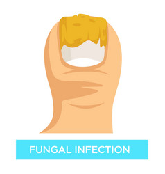 Nail Fungal Infection Royalty Free Vector Image