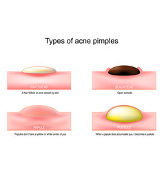 Types of acne pimples Royalty Free Vector Image