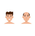 hair stages loss types of baldness on male head vector image
