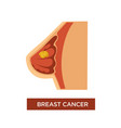 breast cancer female oncology and tumor in chest vector image