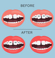 teeth with brace correction before and after vector image