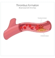 blood vessel and clot thrombus vector image