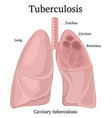 Pulmonary tuberculosis Royalty Free Vector Image