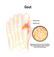 gout is a form of inflammatory arthritis vector image vector image