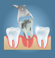 tooth extraction medical poster design vector image vector image